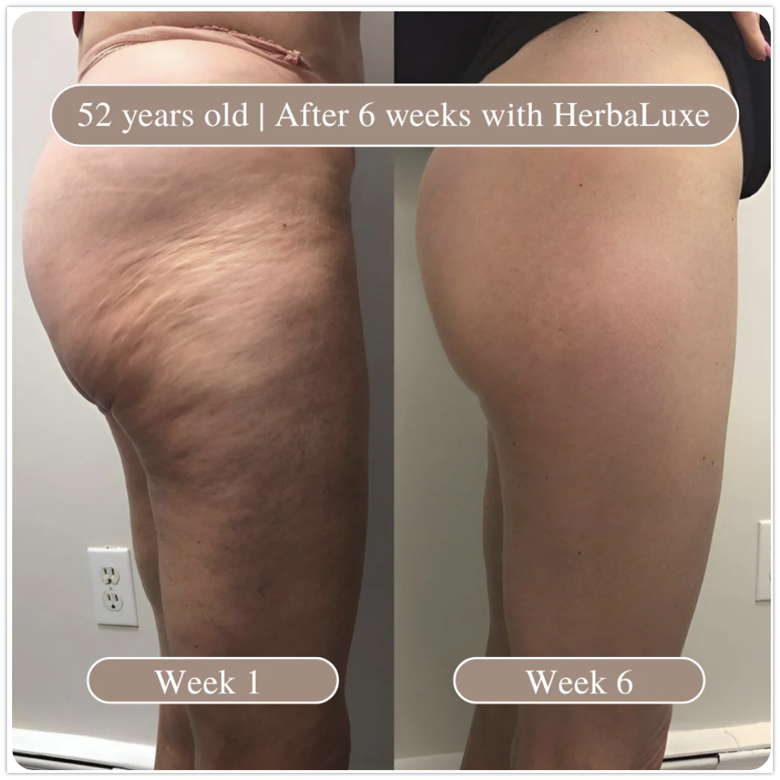 Yumora™ Anti Cellulite Massage Oil