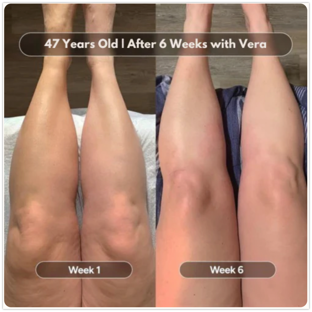Yumora™ Anti Cellulite Massage Oil
