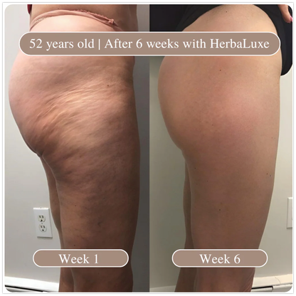 Yumora™ Anti Cellulite Massage Oil