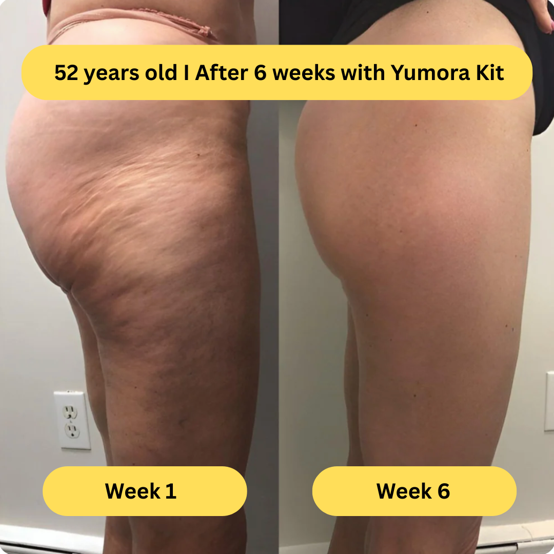 Yumora™ Anti Cellulite Massage Kit