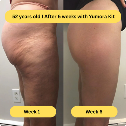 Yumora™ Anti Cellulite Massage Kit