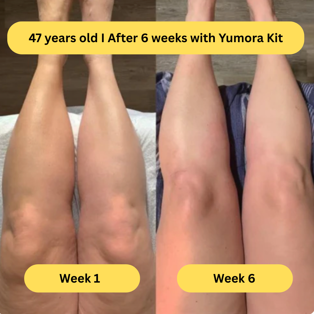 Yumora™ Anti Cellulite Massage Kit